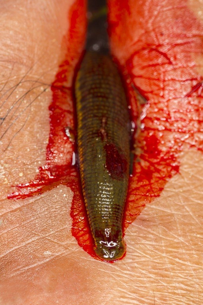 Top 10 Craziest Beauty Treatments 7 Leeching