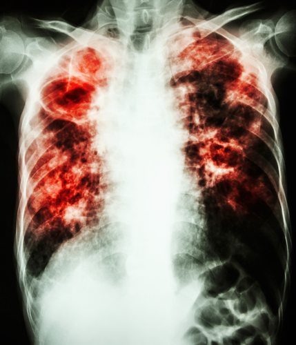 X-ray of Tuberculosis Infected Lung 