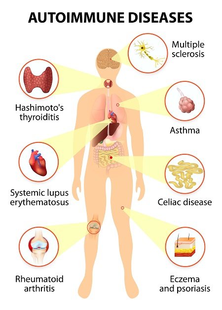 Autoimmune diseases are numerous