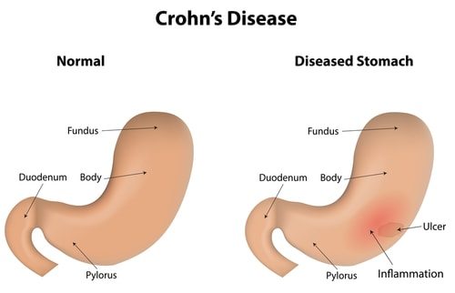 Crohn's Disease explained