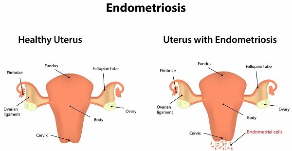Top 10 Facts about the Invention of the Birth Control Pill 3 Norethinrone was used to treat endometriosis