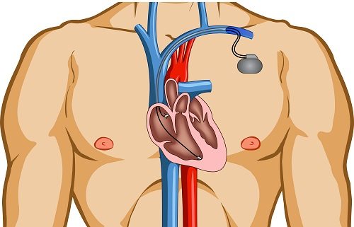 10 Accidental Inventions We Can’t Live Without 1 Accidental Invention,the Pacemaker