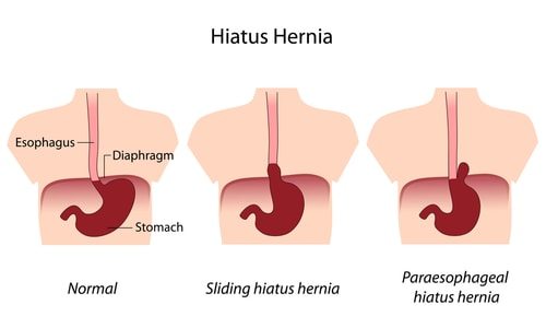 Why Do I Get Acid Reflux? Top 10 Causes of Acid Reflux 3 Your Acid Reflux might be a hernia.