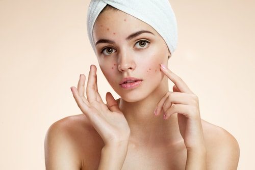 how-to-get-rid-of-acne-in-10-simple-steps