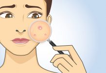 10 Reasons Why You’re Breaking Out In Acne In Your 30s 10 Reasons Why You're Breaking Out In Acne In Your 30s