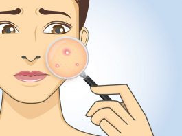 10 Reasons Why You're Breaking Out In Acne In Your 30s
