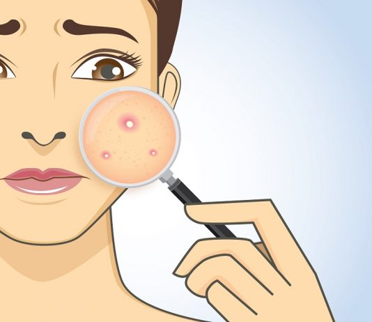 10 Reasons Why You're Breaking Out In Acne In Your 30s