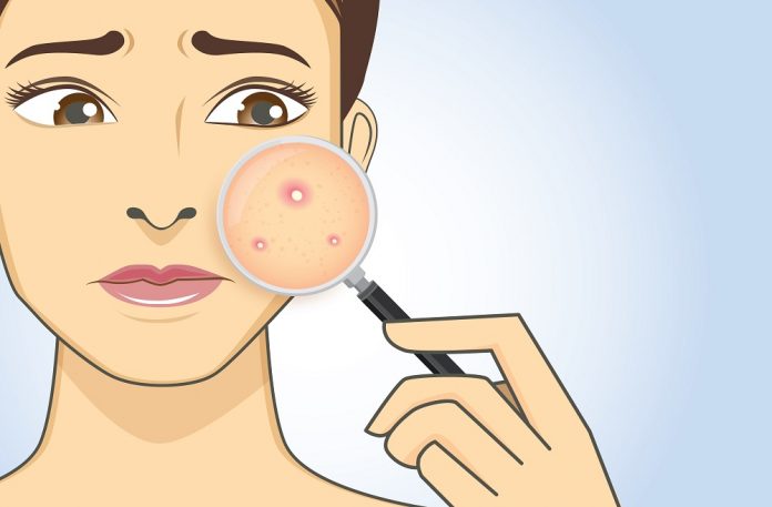 10 Reasons Why You're Breaking Out In Acne In Your 30s