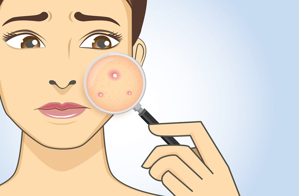 10 Reasons Why You're Breaking Out In Acne In Your 30s