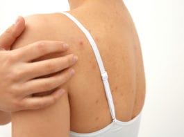 Acne on Your Back