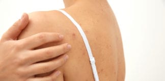 Acne on Your Back