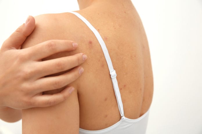Acne on Your Back Acne on Your Back