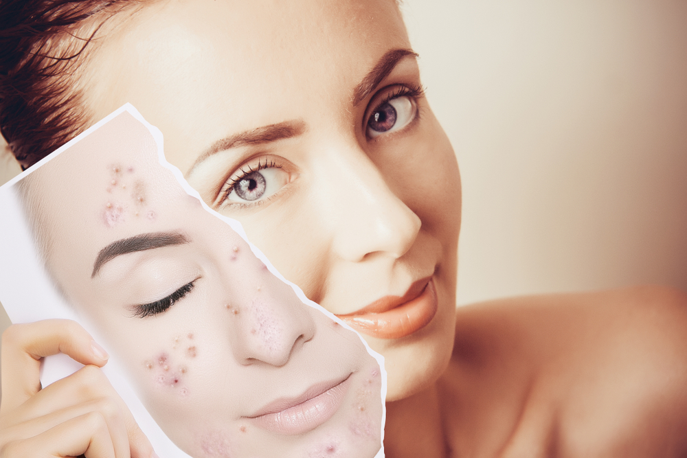 10 Reasons You Are Breaking out in Acne on Your Cheeks 1 Is It Even Acne