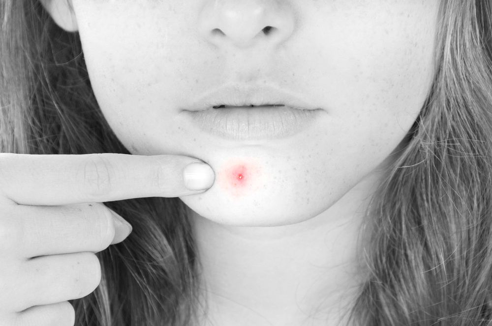 10 Reasons You are breaking out in acne on your chin